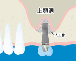 増骨手術