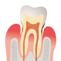 歯周病
